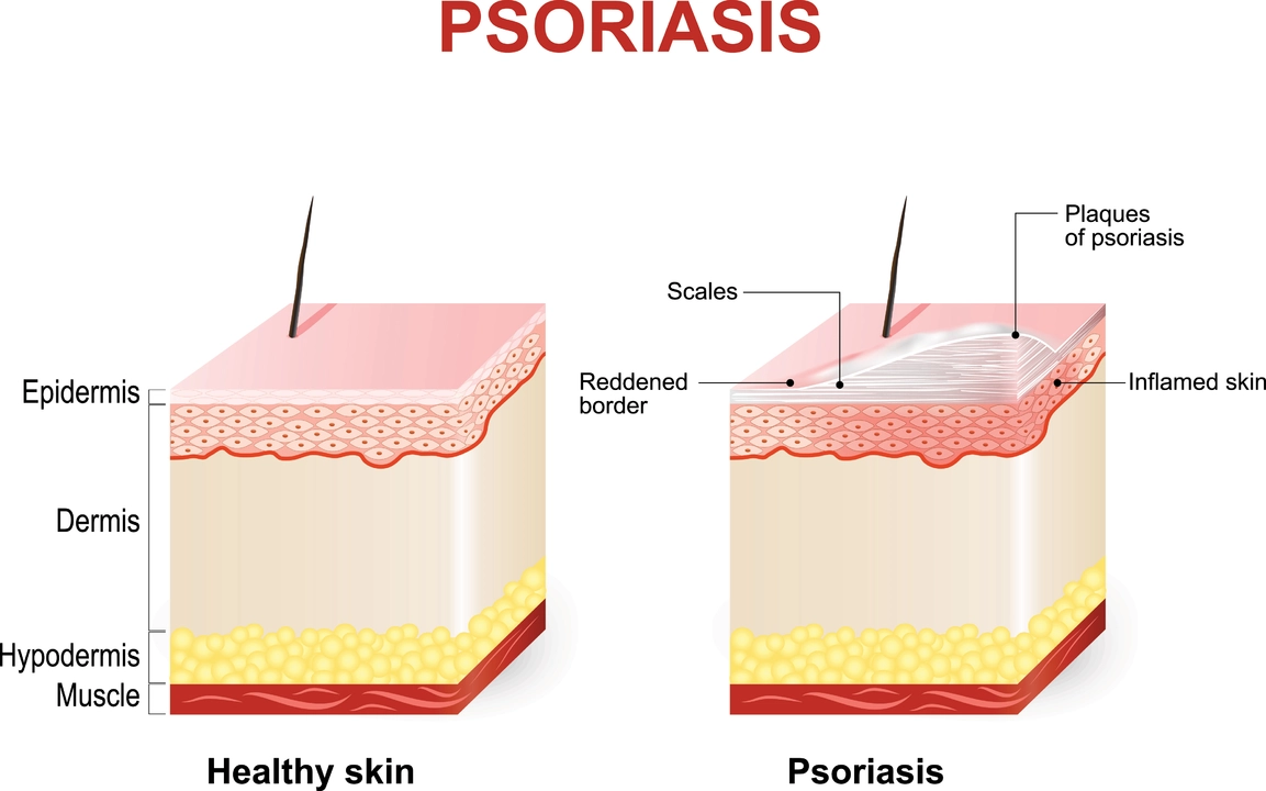 How to Manage Plaque Psoriasis at Work